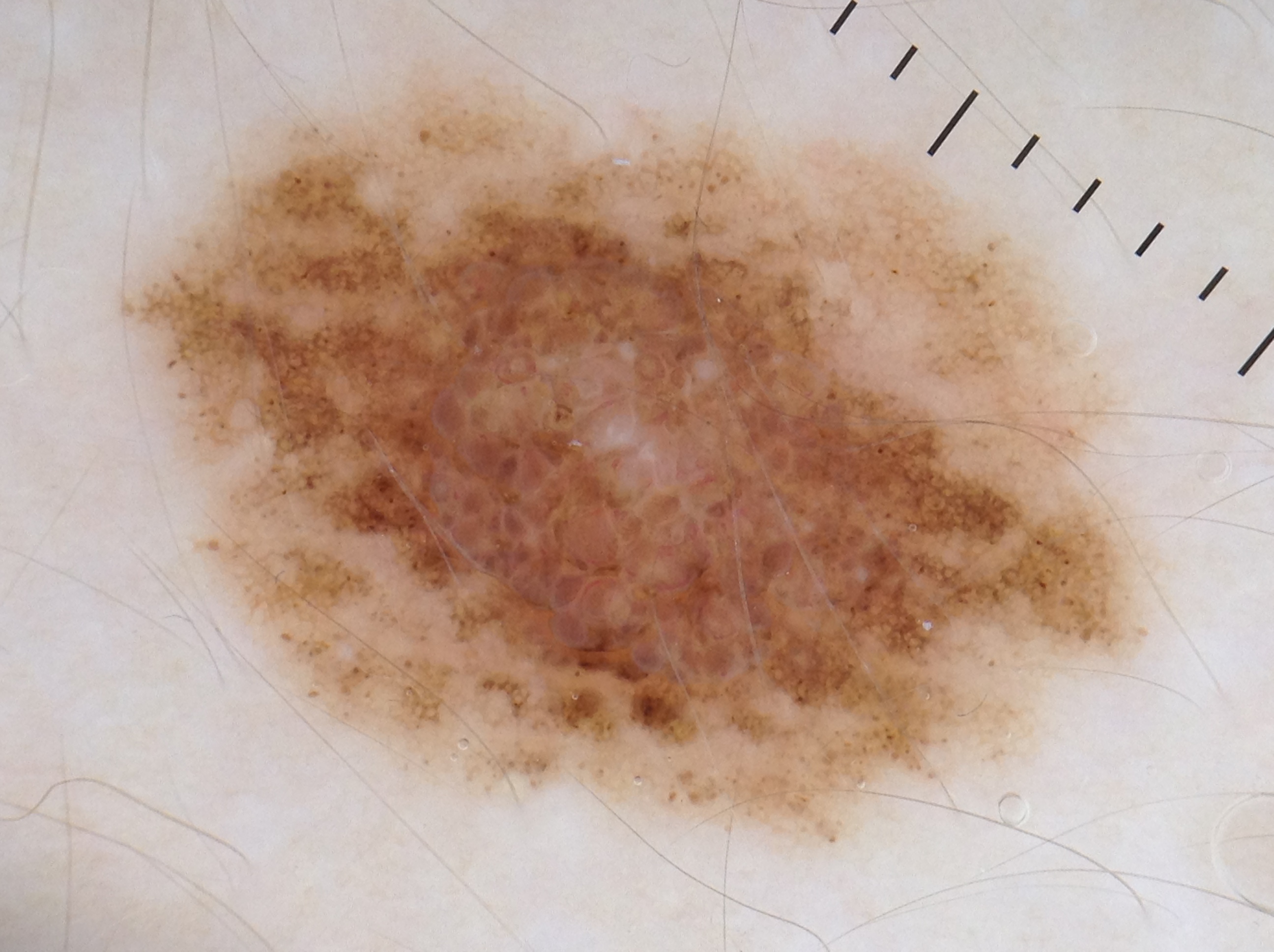 sospetto melanoma