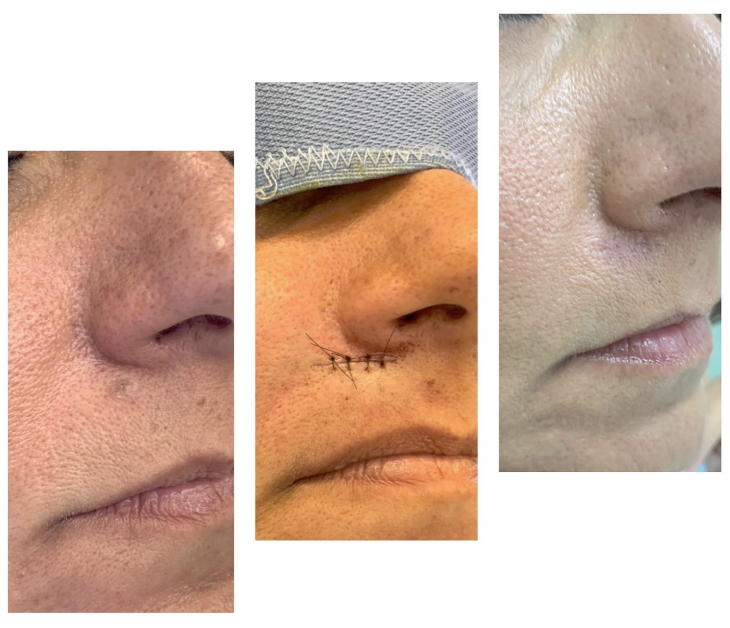 asportazione chirurgica epitelioma