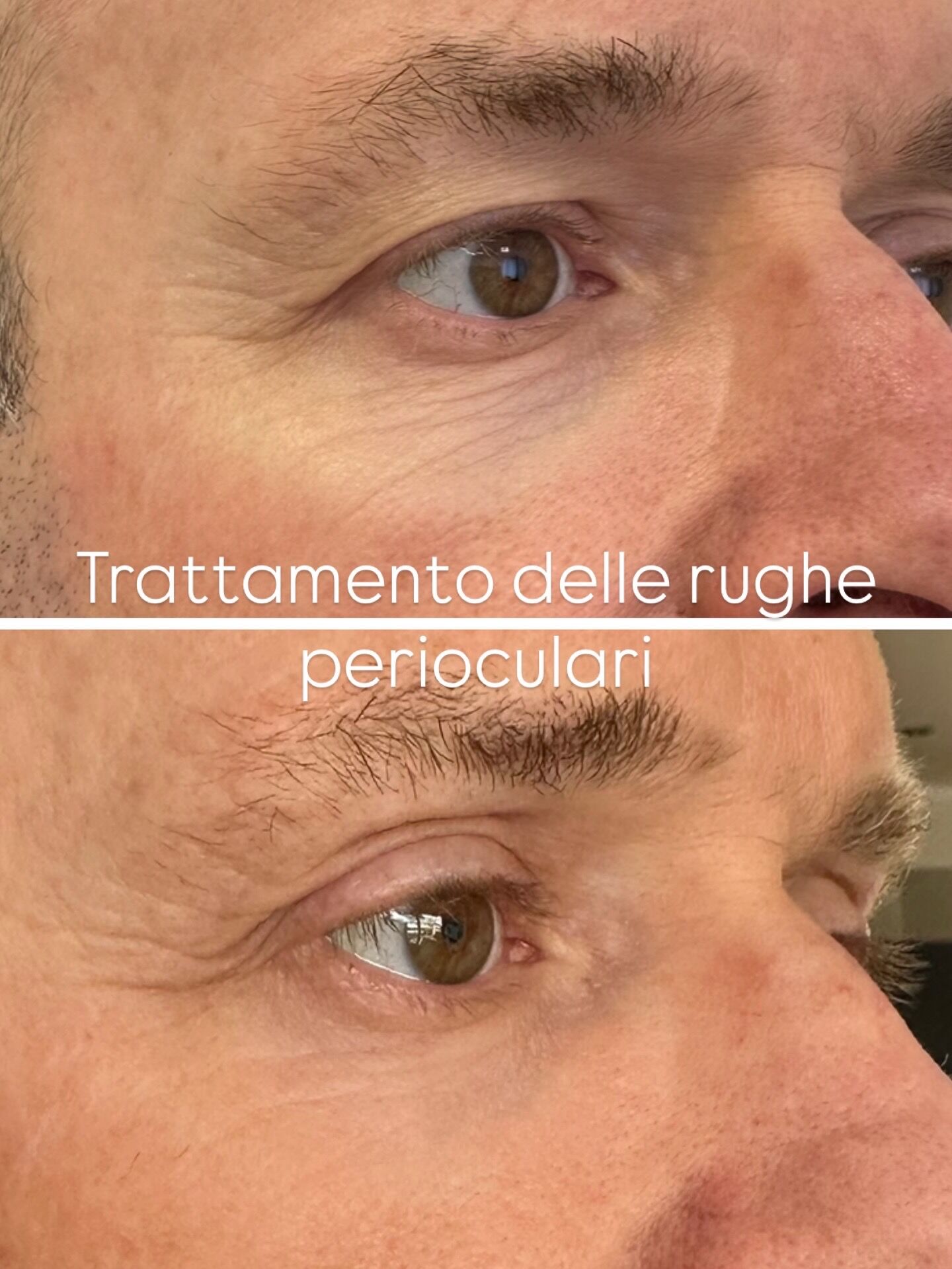 blefaroplastica laser