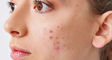 Acne